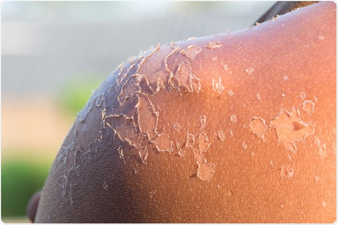 Peeling shoulder from suburn. Image Credit: Myibean / Shutterstock